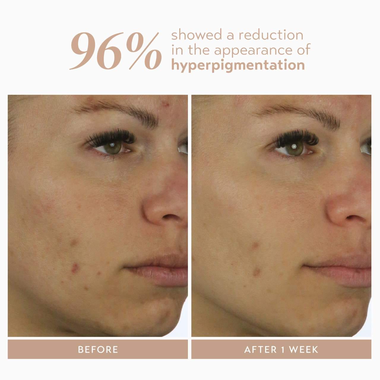 Сыворотка с 10% азелаинового комплекса от пигментных пятен Shani Darden Skin Care Rescue — фото 5