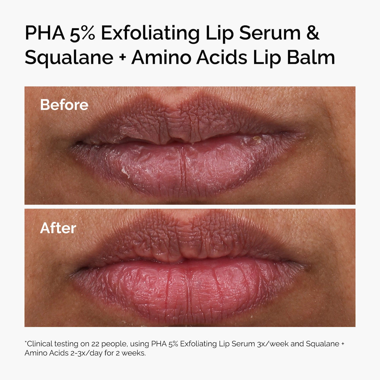 PHA 5% Exfoliating Lip Serum - The Ordinary