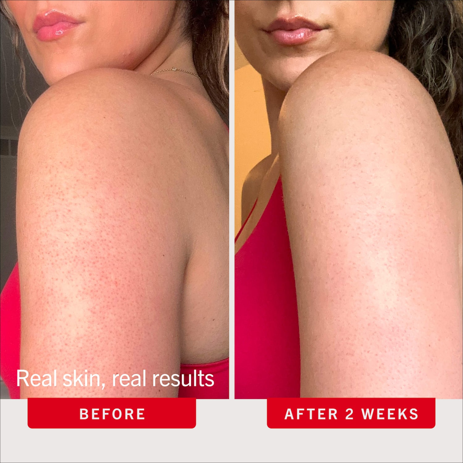 KP Bump Eraser Body Scrub with 10% AHA – Exfoliant for Keratosis Pilaris
