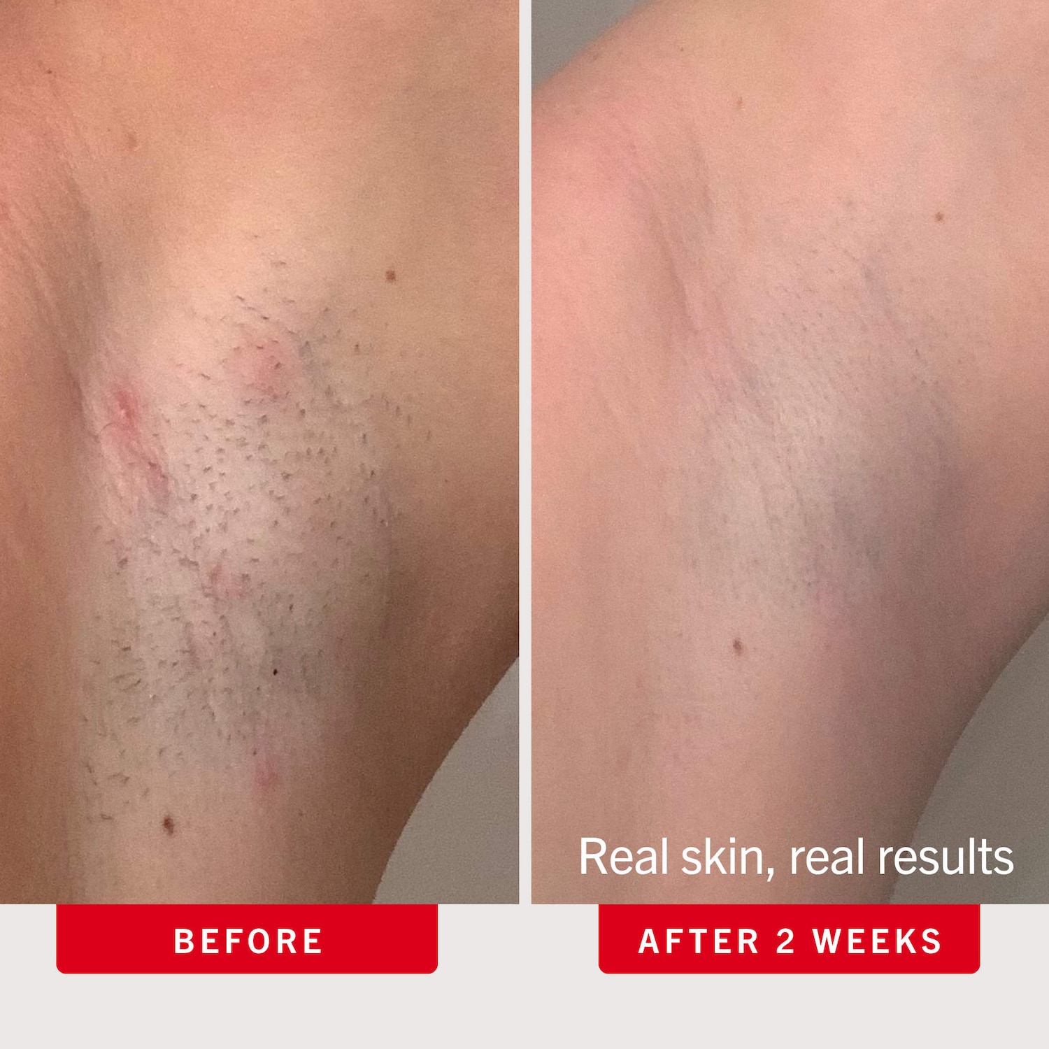 Rondelles pour poils incarnés avec BHA et AHA le corps + visage