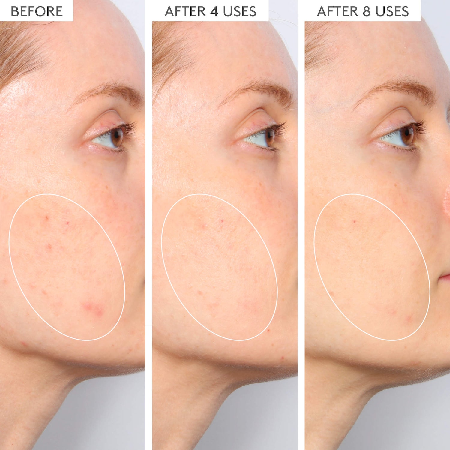 TLC Sukari Babyfacial 25% AHA/ 2% BHA Exfoliating Mask - Drunk