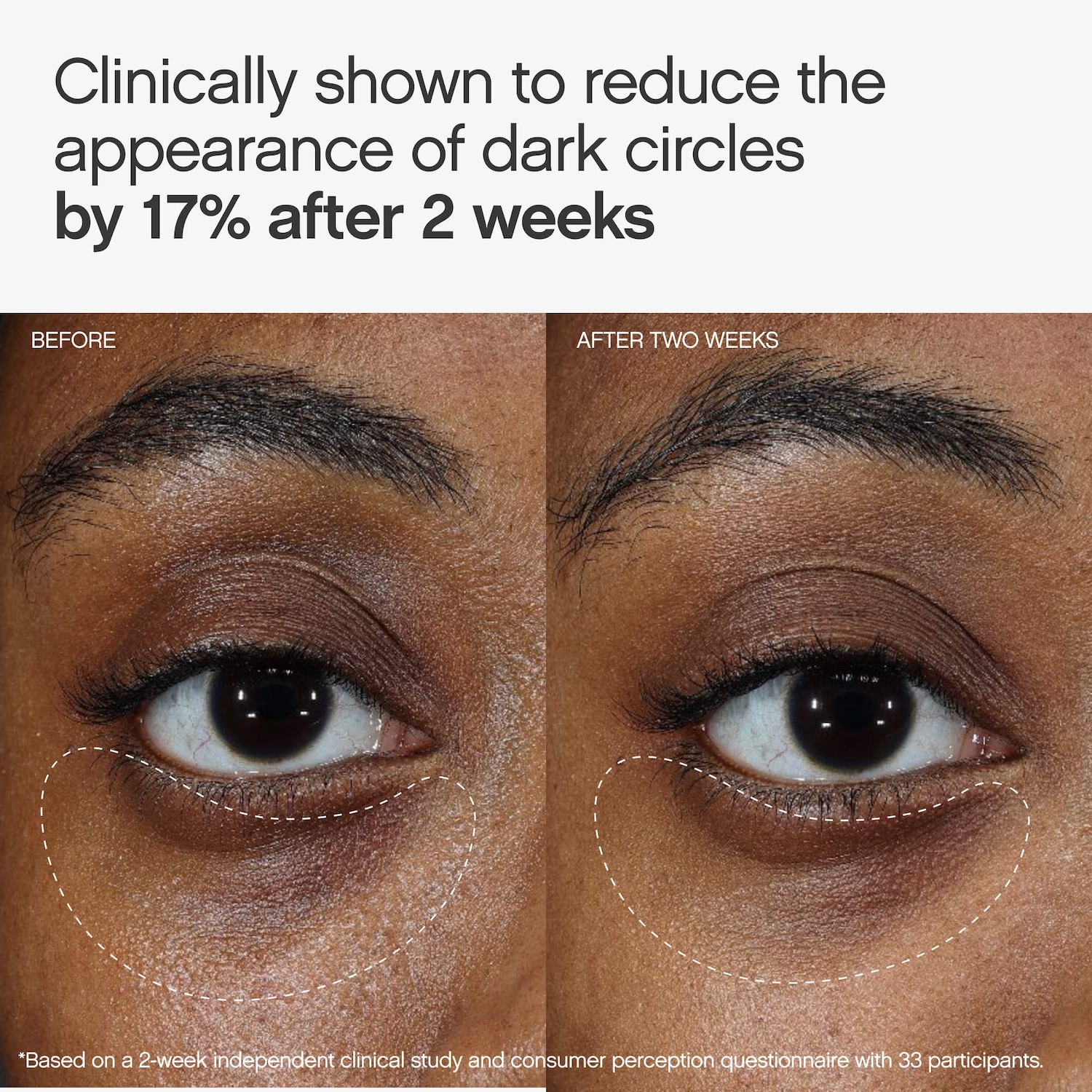does glutathione remove dark circles These eye patches are packed with glutathione, kojic acid & vitamin C to help care for circles, pigmentation, and tired looking under eyes., I also loved how well they stayed in place without Faded Under Eye Brightening &