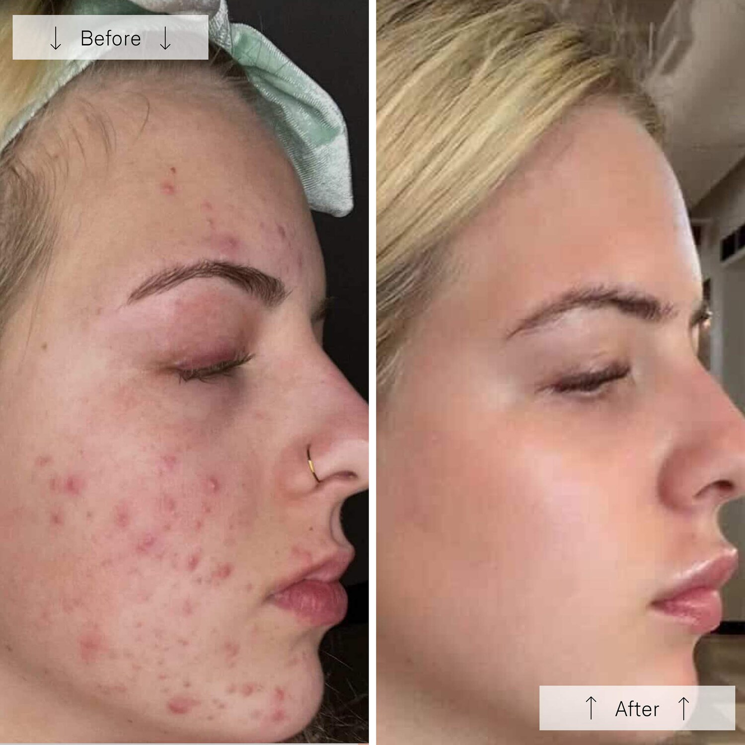 LED-маска для лица Omnilux Clear Skin с синим и красным светом — фото 5