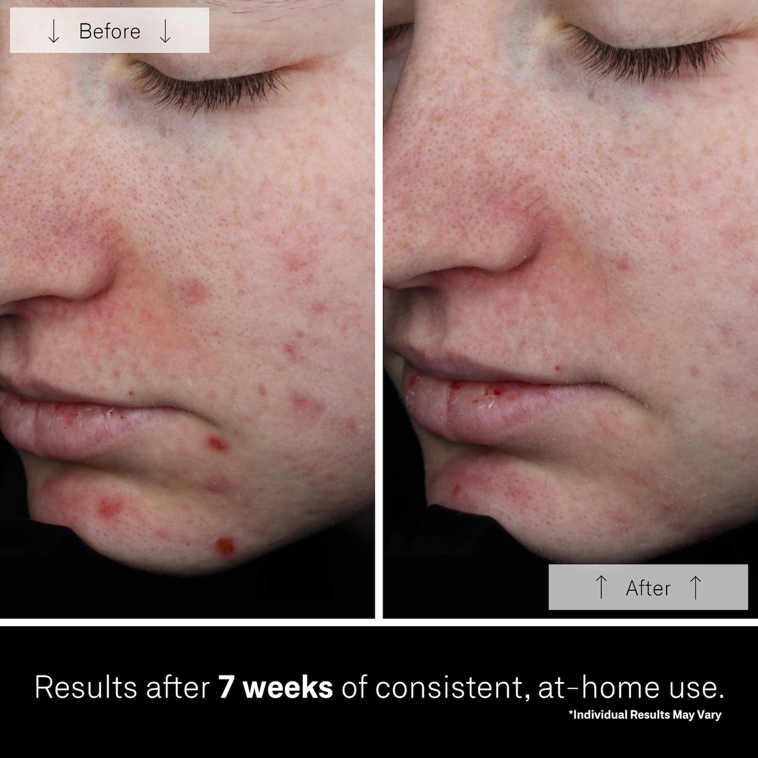 LED-маска для лица Omnilux Clear Skin с синим и красным светом — фото 6
